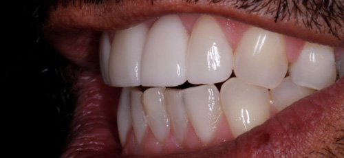 Close up of a man smiling after replacing a missing upper tooth