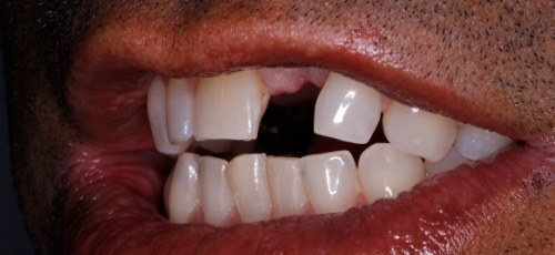 Close up of a man smiling with a missing upper tooth