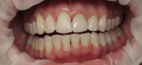 Close up of a mouth with evenly aligned upper and lower teeth