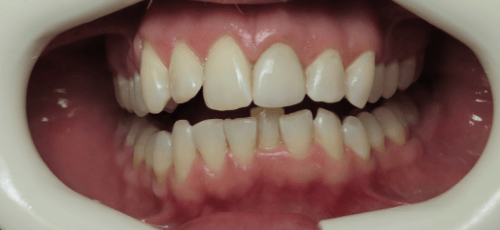 Close up of a mouth with misaligned upper and lower teeth