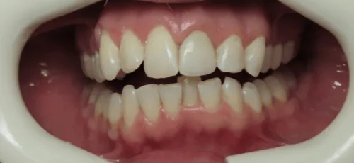 Close up of a mouth with misaligned upper and lower teeth