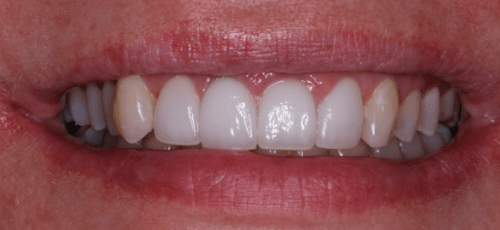 Close up of a smile after replacing one missing upper tooth