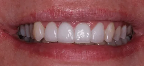 Close up of a smile after replacing one missing upper tooth
