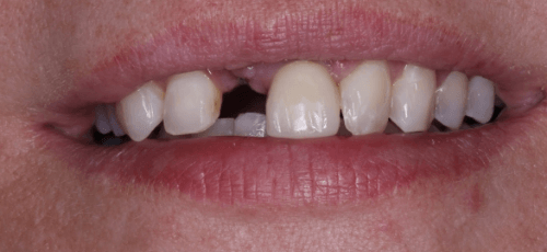 Close up of a smile with one missing upper tooth