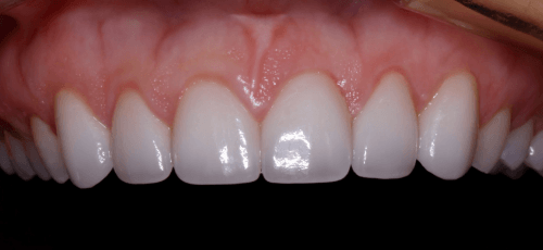 Upper row of teeth with no chips