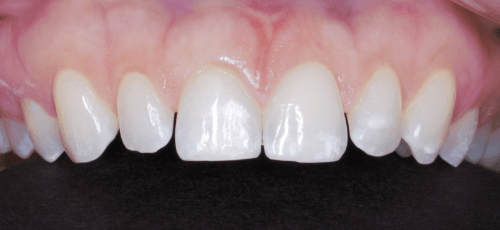 Upper row of slightly chipped teeth