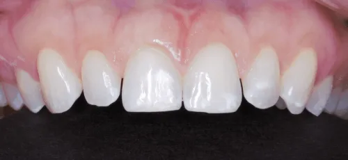 Upper row of slightly chipped teeth