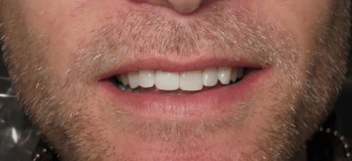 Man smiling with a natural looking set of teeth