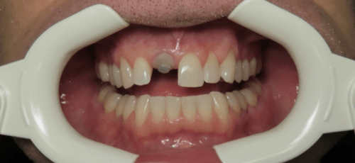 Man smiling with a visible dental implant abutment in upper arch