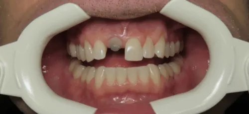 Man smiling with a visible dental implant abutment in upper arch