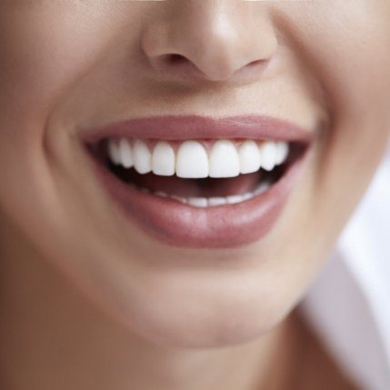 Closeup of flawless smile after makeover