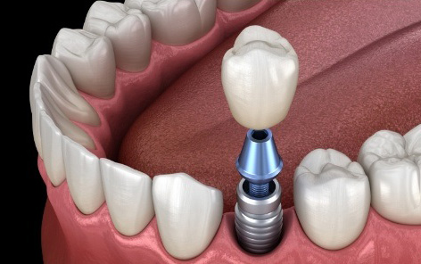 Animated smile during dental implant supported dental crown placement