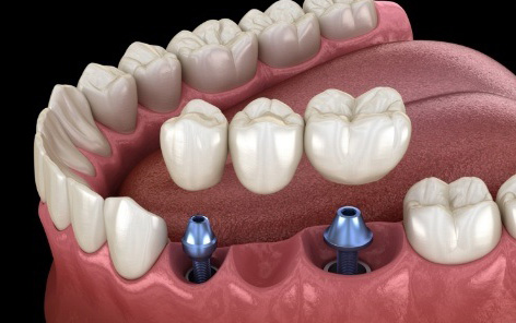 Animated smile during dental implant supported fixed bridge placement