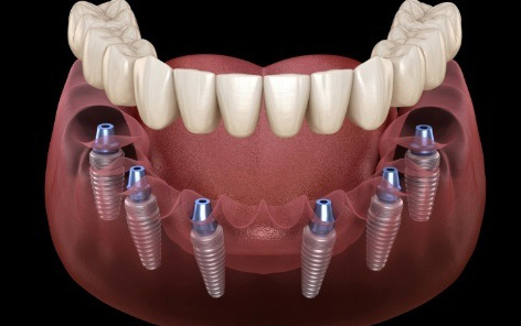 Animated smile during dental implant supported denture placement