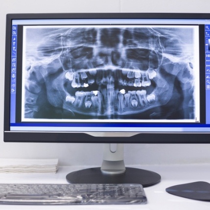 Digital x rays on chairside computer monitor