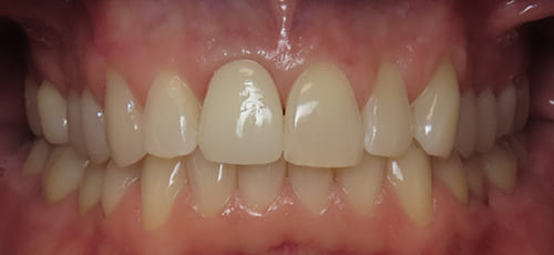 Mouth after restoring dental implant with a flawless crown