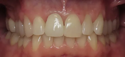 Mouth after restoring dental implant with a flawless crown