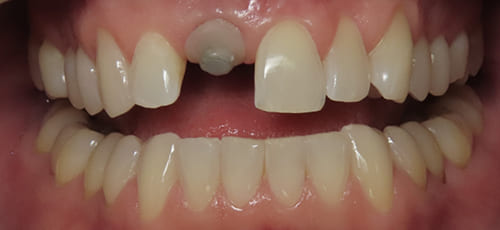 Mouth with a visible dental implant abutment in place of a missing upper tooth