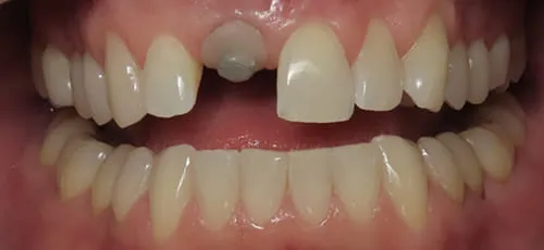 Mouth with a visible dental implant abutment in place of a missing upper tooth