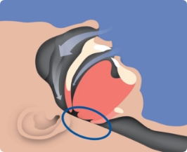 Illustration of a person sleeping on their back with a blocked airway