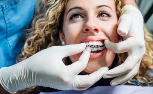Dentist placing Invisalign aligner on patient's top teeth