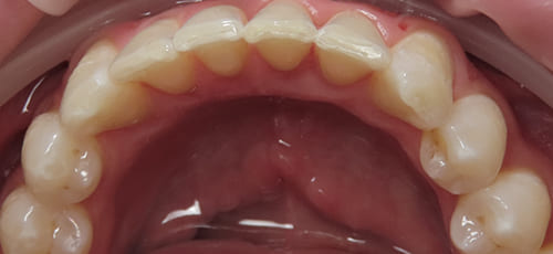 Aerial view of an arch of evenly aligned teeth