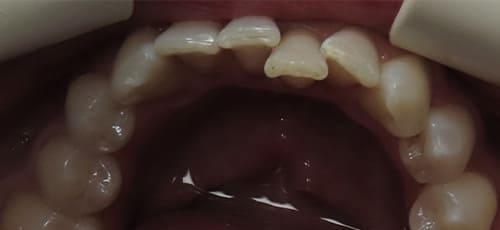 Aerial view of an arch of misaligned teeth