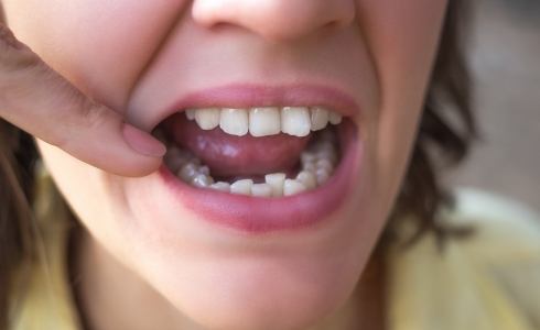 Closeup of smile with crowded teeth