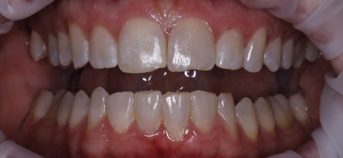Mouth with well aligned lower teeth
