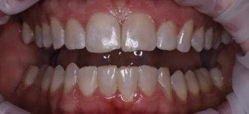Mouth with well aligned lower teeth