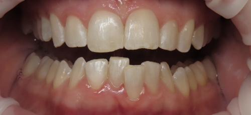 Mouth with misaligned lower teeth
