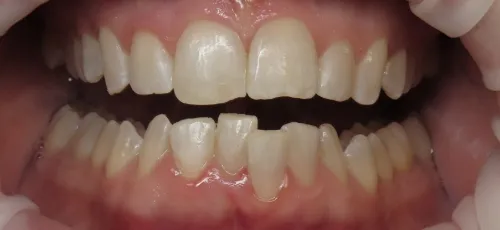 Mouth with misaligned lower teeth