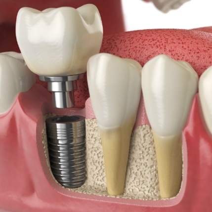 Animated smile during dental implant placement