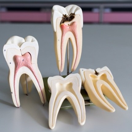 Model of a healthy tooth and tooth in need of root canal treatment