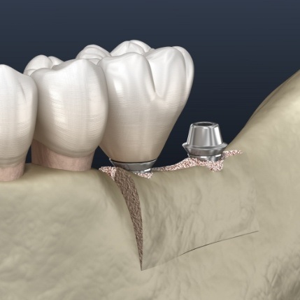 Animated smile during dental implant placement