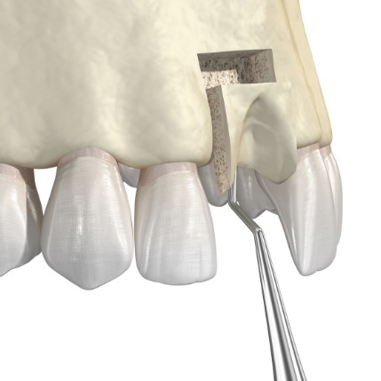 Animated smile during bone grafting