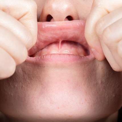 Closeup of smile after frenectomy