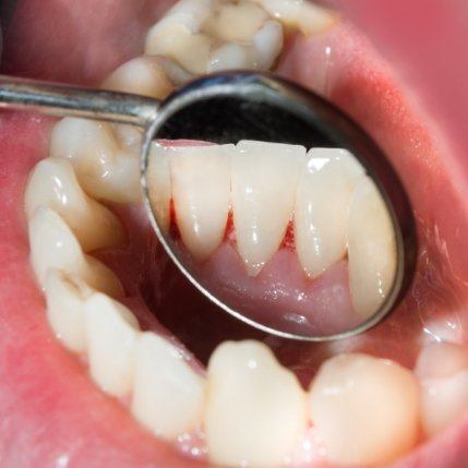 Closeup of smile during oral cancer screening