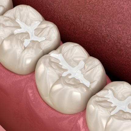 Animated smile with dental sealants