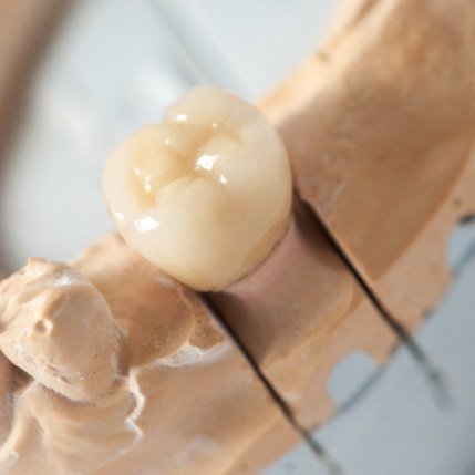 Model smile with dental crown restoration