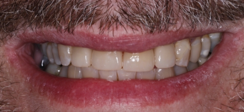 Smile after correcting severe tooth discoloration