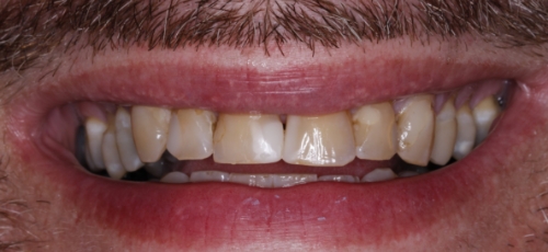 Smile with severe tooth discoloration