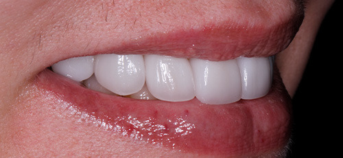 Person smiling with flawless white teeth