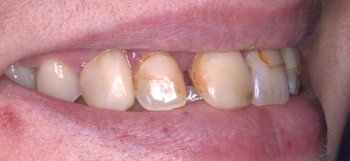Person smiling with cracked and yellowed teeth