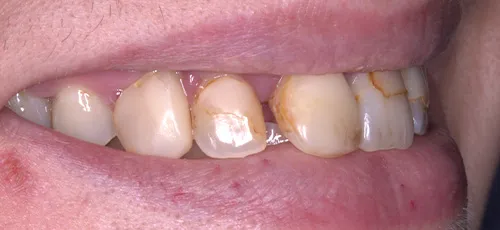 Person smiling with cracked and yellowed teeth
