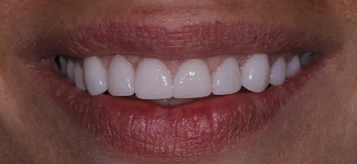 Smile with whiter and evenly aligned teeth