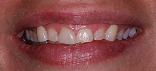 Smile with slightly uneven and discolored teeth