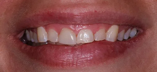 Smile with slightly uneven and discolored teeth