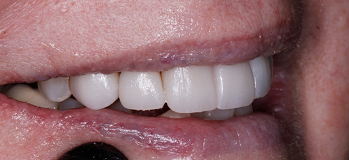 Close up of a smile with newly restored white teeth