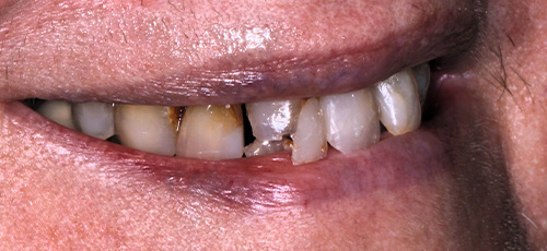 Close up of a smile with severely stained and damaged teeth